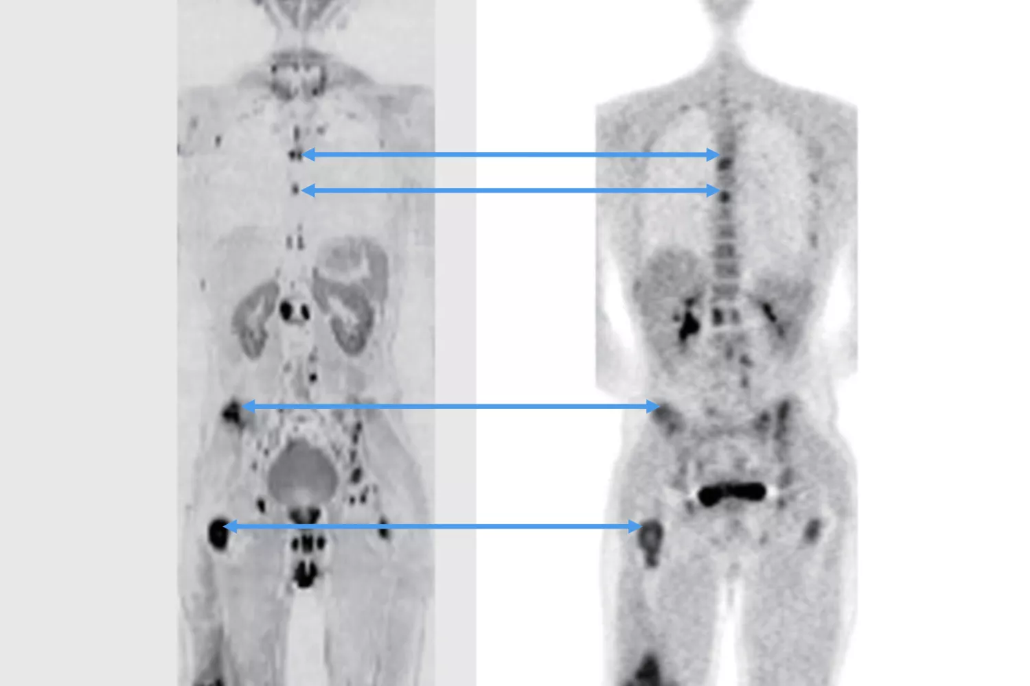 磁力共振(MRI)类PET成像