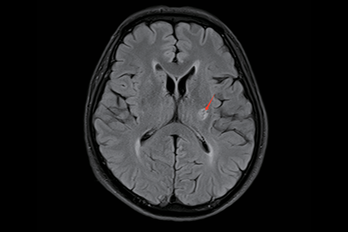 陳舊性腦梗塞T2，Flair，Tra