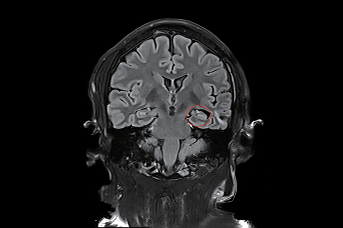 癲癇（海馬萎縮）T2，Flair，Cor