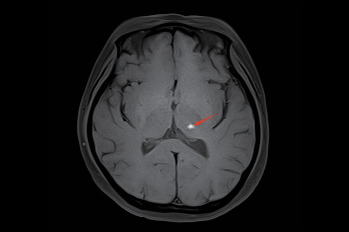 腦出血T1，Fs，Tra