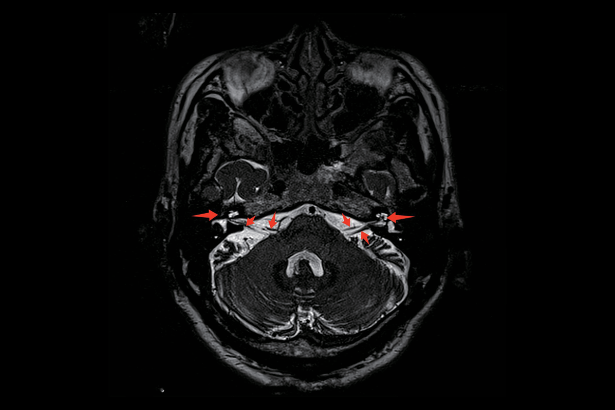 內耳/面神經/聽神經T2，Spc，Tra