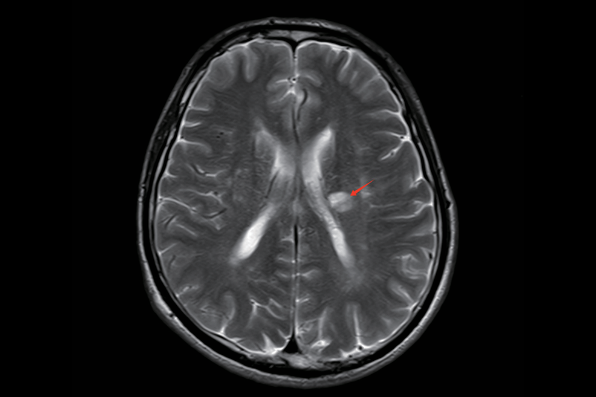 急性腦梗塞T2，Tra