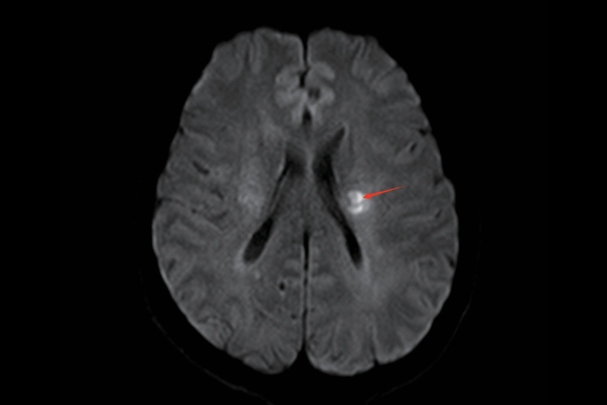急性腦梗塞DWI（b值=1000）