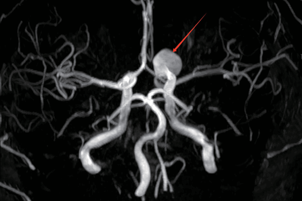 腦部血管MRA/動脈瘤