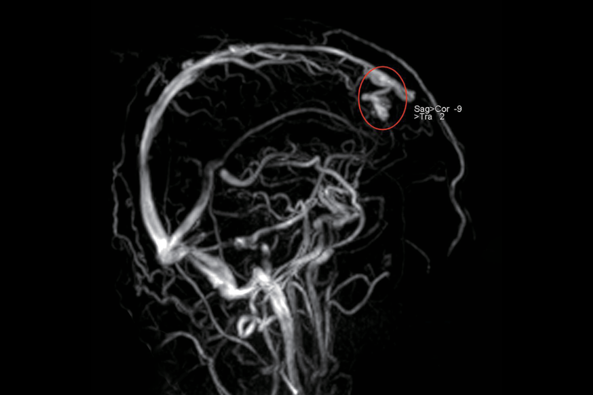 腦部動靜脈畸形AVM
