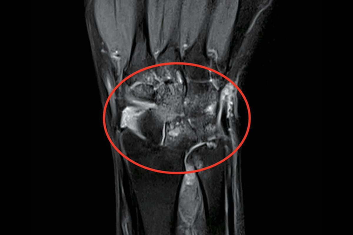 腕關節壓脂Pd，Fs，Cor<br>（積液，水腫，囊變）
