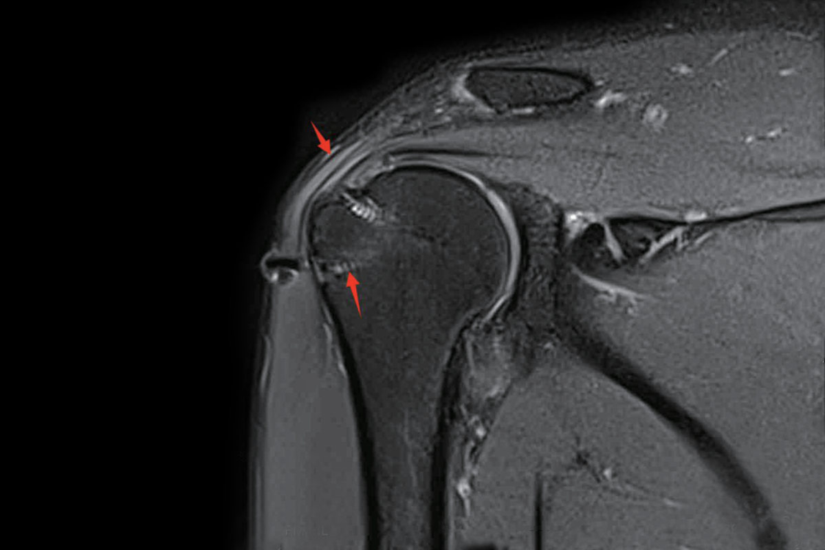 肩關節壓脂Pd，Fs，Cor <br>（肩袖損傷術後改變）