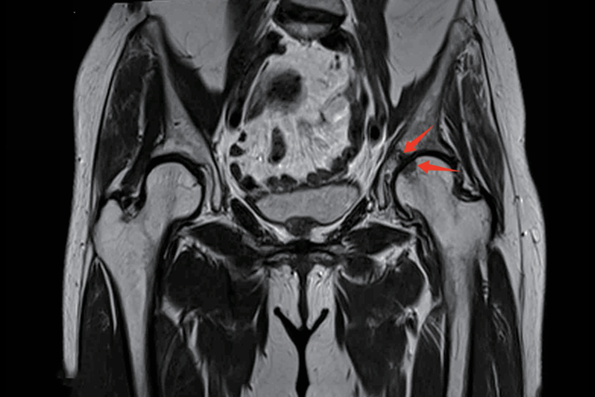 髖關節T2，Cor<br>（囊變，積液）