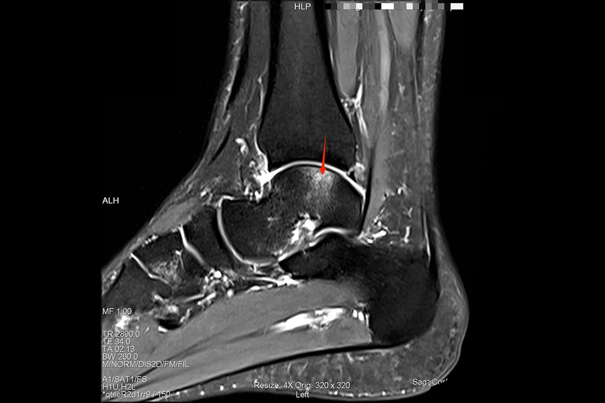 踝關節Pd，Fs，Sag<br>（水腫，軟骨損傷）