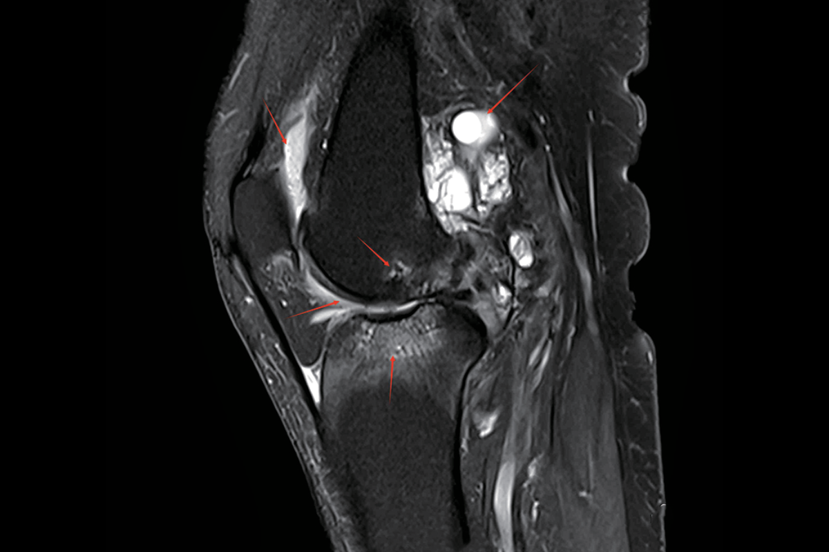 膝關節膝關節壓脂Pd，Fs，Sag<br>（關節炎，腔積液，囊腫）