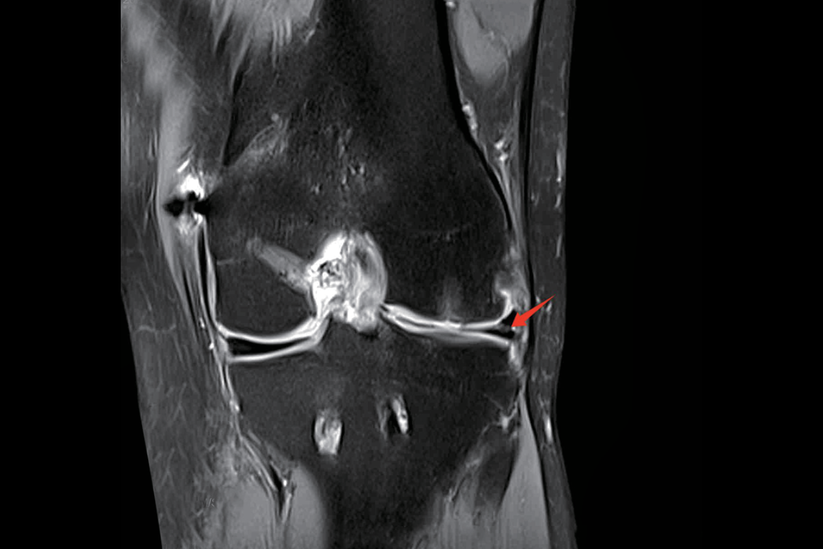 半月板損傷Pd，Fs，Cor<br>（后角III度損傷）