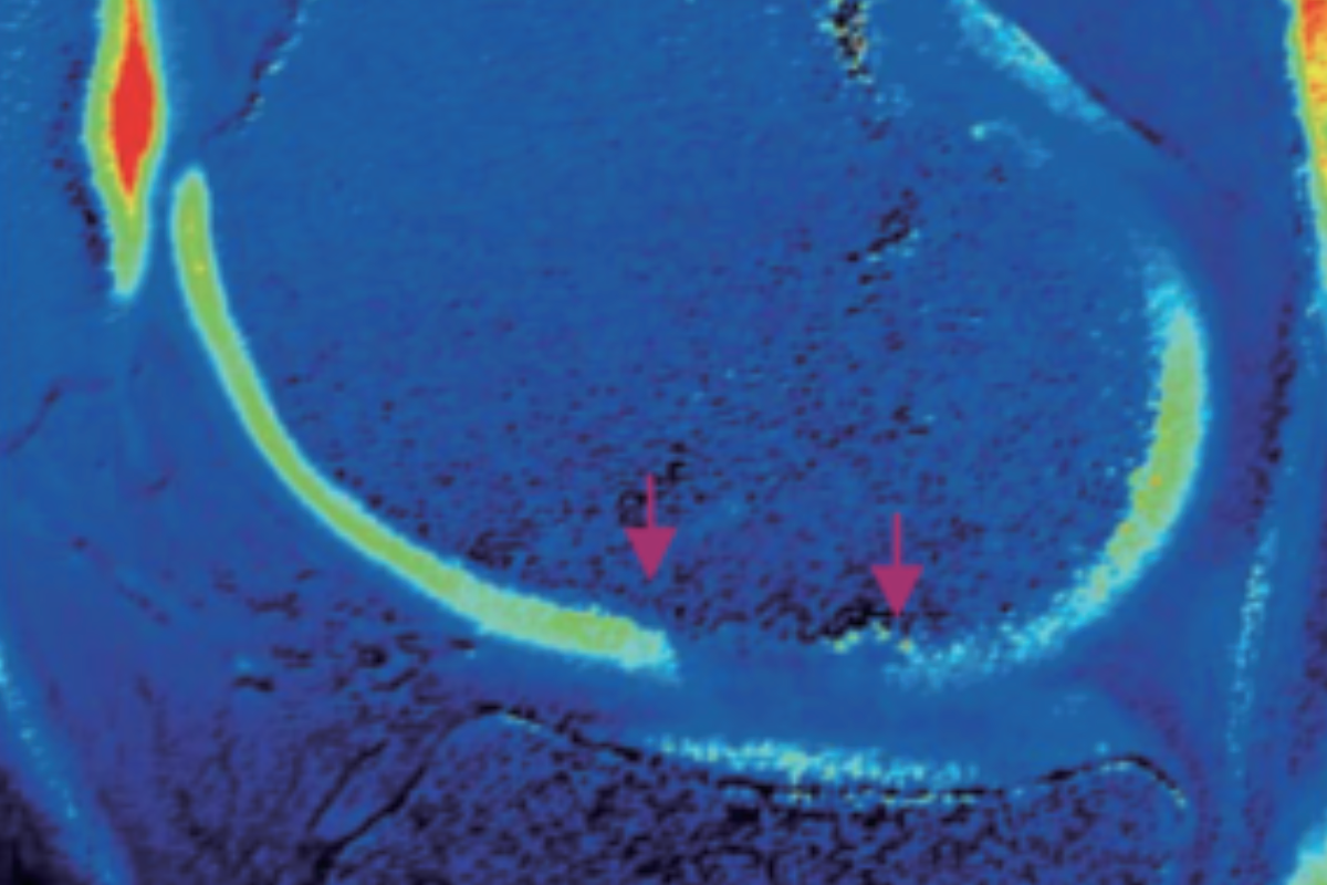 膝關節軟骨T1 Mapping（軟骨損傷）