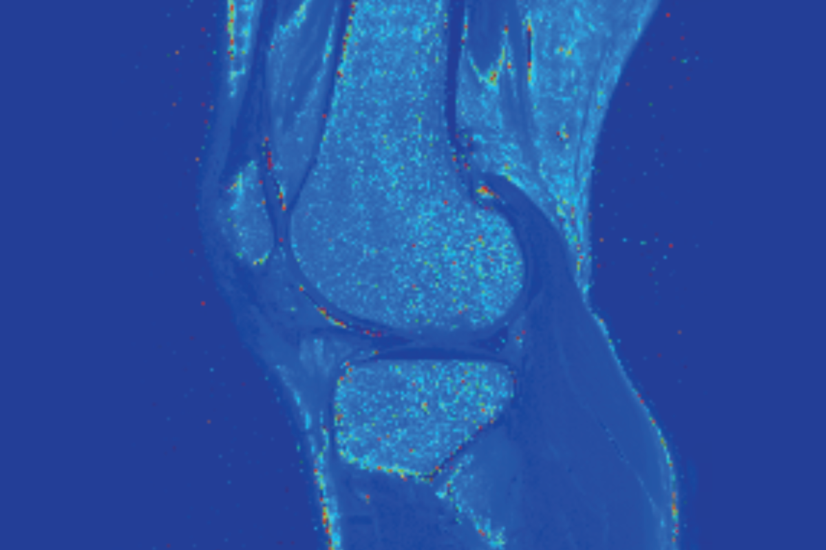 膝關節軟骨T2 Mapping（軟骨損傷）