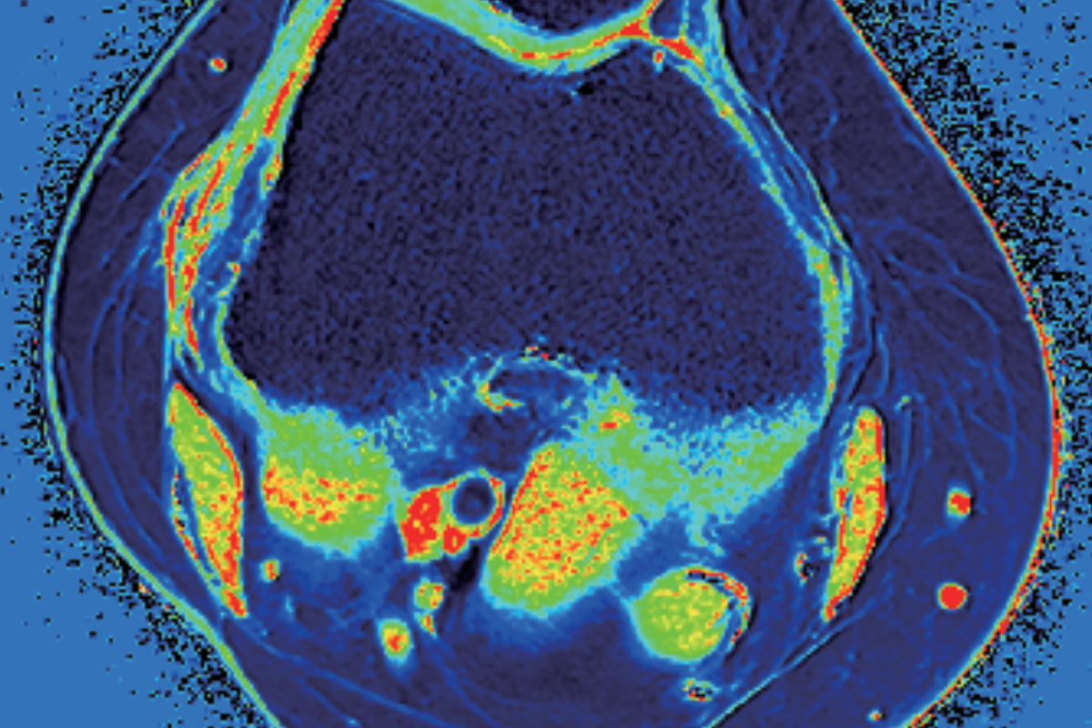 膝關節軟骨T2* Mapping（軟骨損傷）