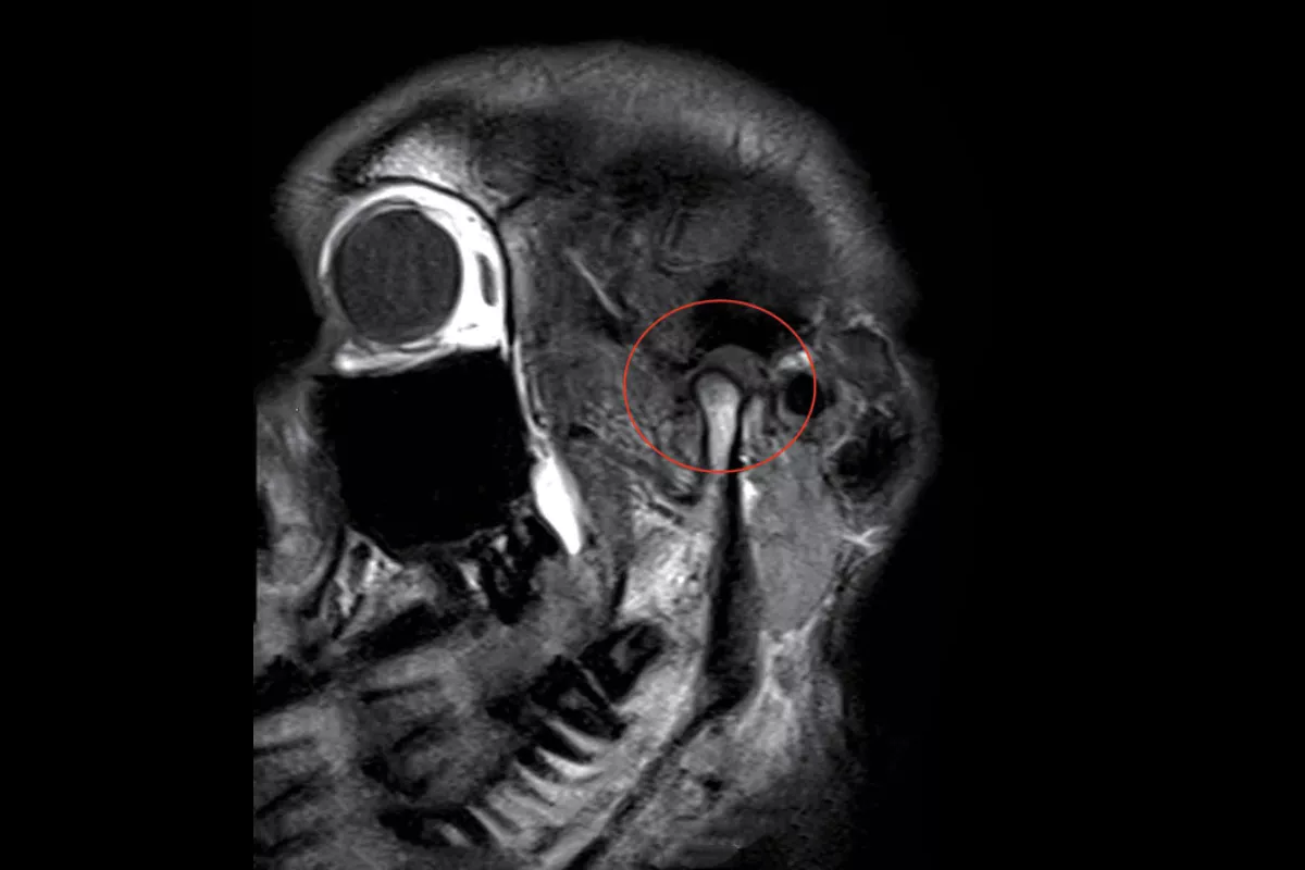 TMJ（开口）