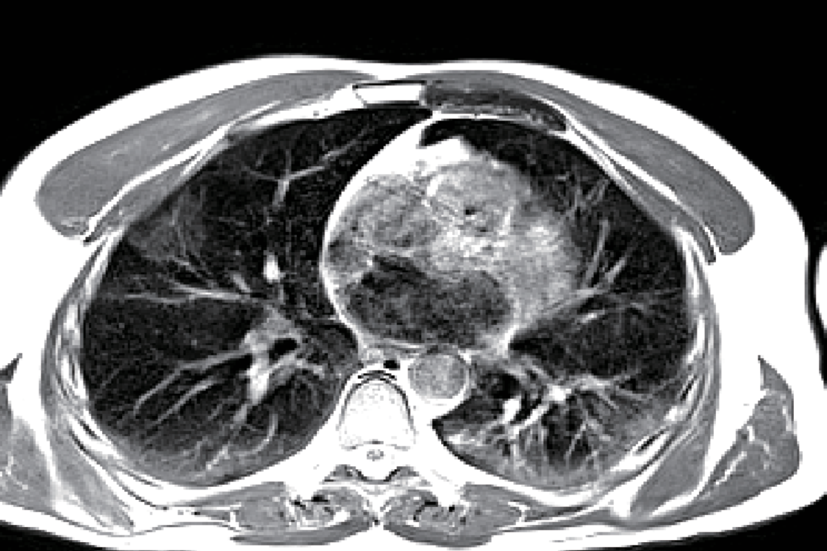 肺部<br>（新冠肺炎，肺部異常）