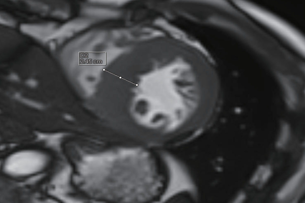 心臟<br>（心機肥厚）