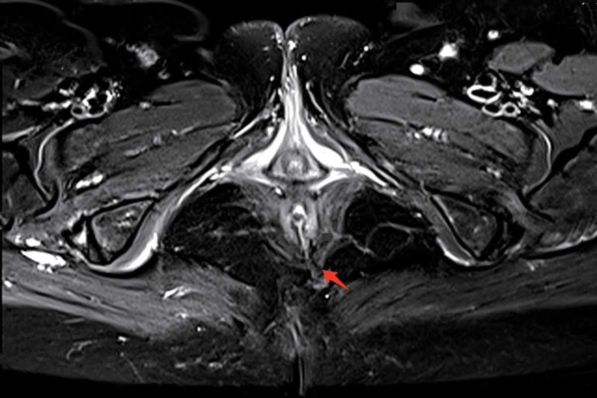 肛門<br>（肛瘺）