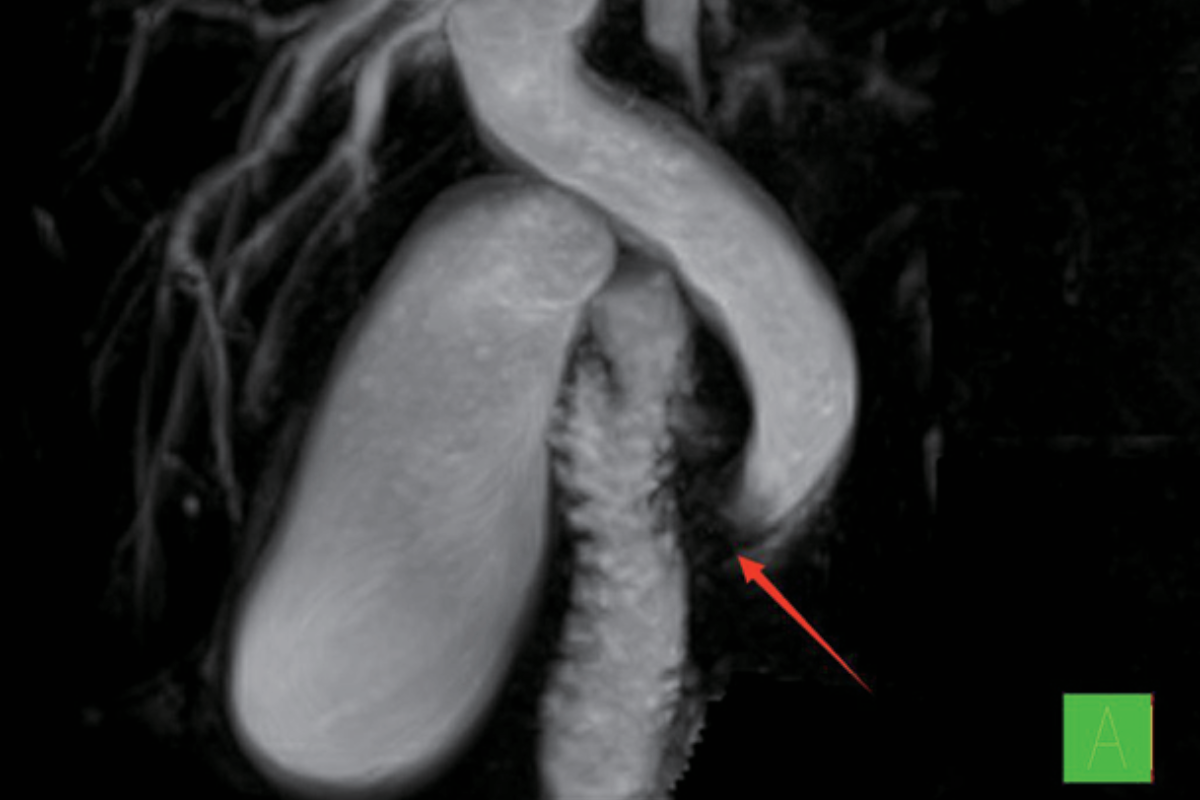 胰膽管造影MRCP（膽道梗阻）