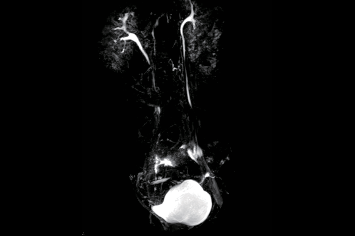 泌尿系造影MRU（雙側輸尿管梗阻）