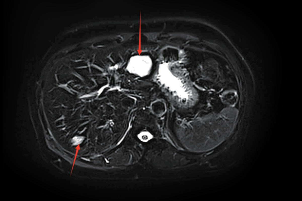肝臟T2，Fs，Tra<br>（血管瘤，囊腫）
