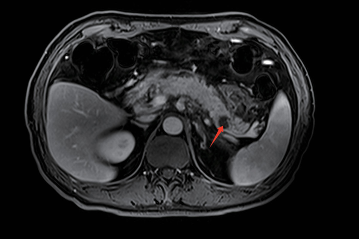 胰腺T1，Fs-dixon，Tra<br>（胰腺癌）