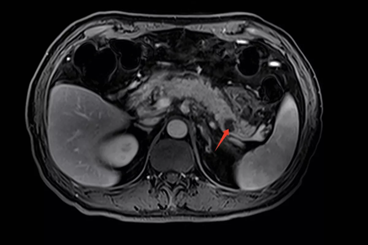 胰腺T1，Fs-dixon，Tra<br>（胰腺癌）