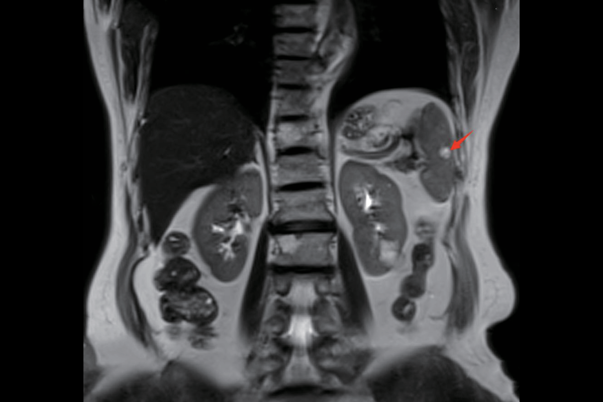 脾臟T2，Cor<br>（脈管類腫瘤）