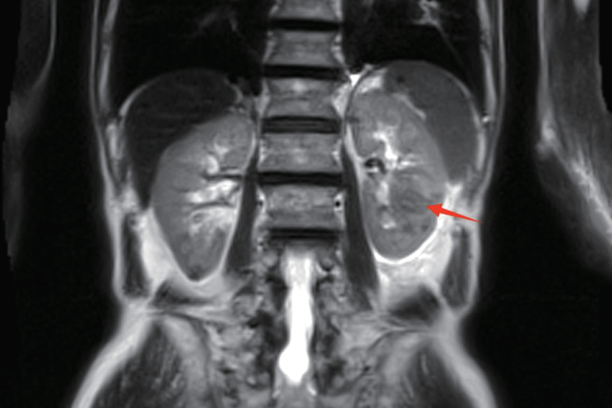 腎臟T2，Cor<br>（原發惡性腫瘤）