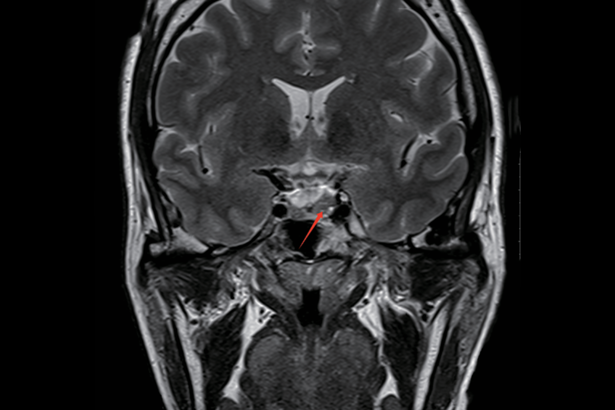 垂體T2，Cor <br>（微腺瘤）