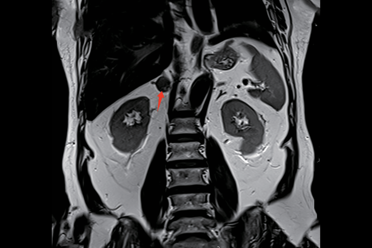 腎上腺T2，Cor<br>（腫瘤）