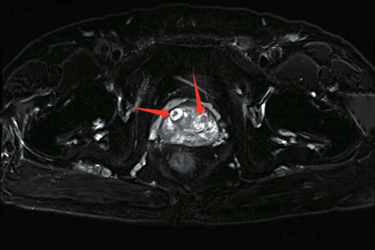 前列腺T2，Fs，Tra<br>（多灶前列腺癌）