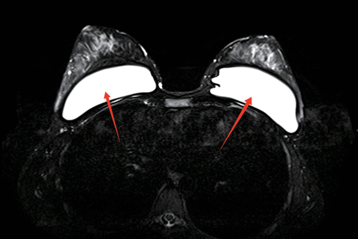 乳腺T2，Fs，Tra<br>（硅膠假體）