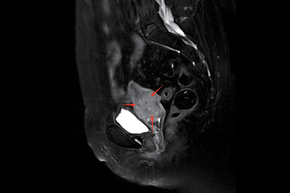 子宮T2，Fs，Sag<br>（宮頸癌）