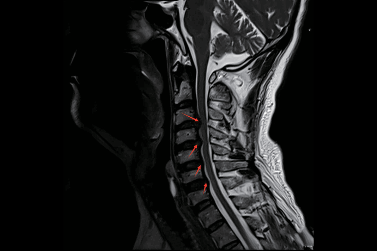 頸椎T2，Sag<br>（多塊椎間盤後緣局限性突出，相應椎管狹窄，脊髓明顯受壓變細）