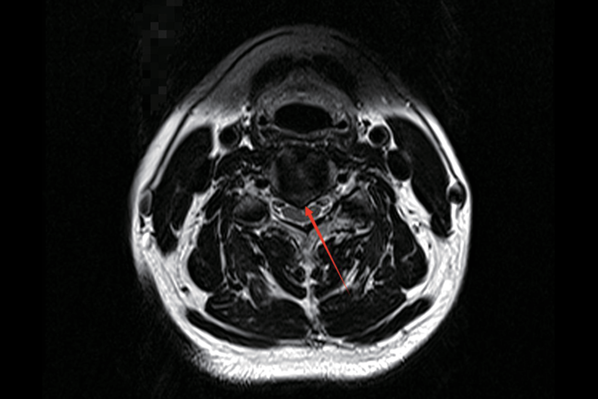 頸椎T2，Tra<br>（椎間盤後緣局限性突出，相應椎管狹窄，脊髓前緣明顯受壓變細）