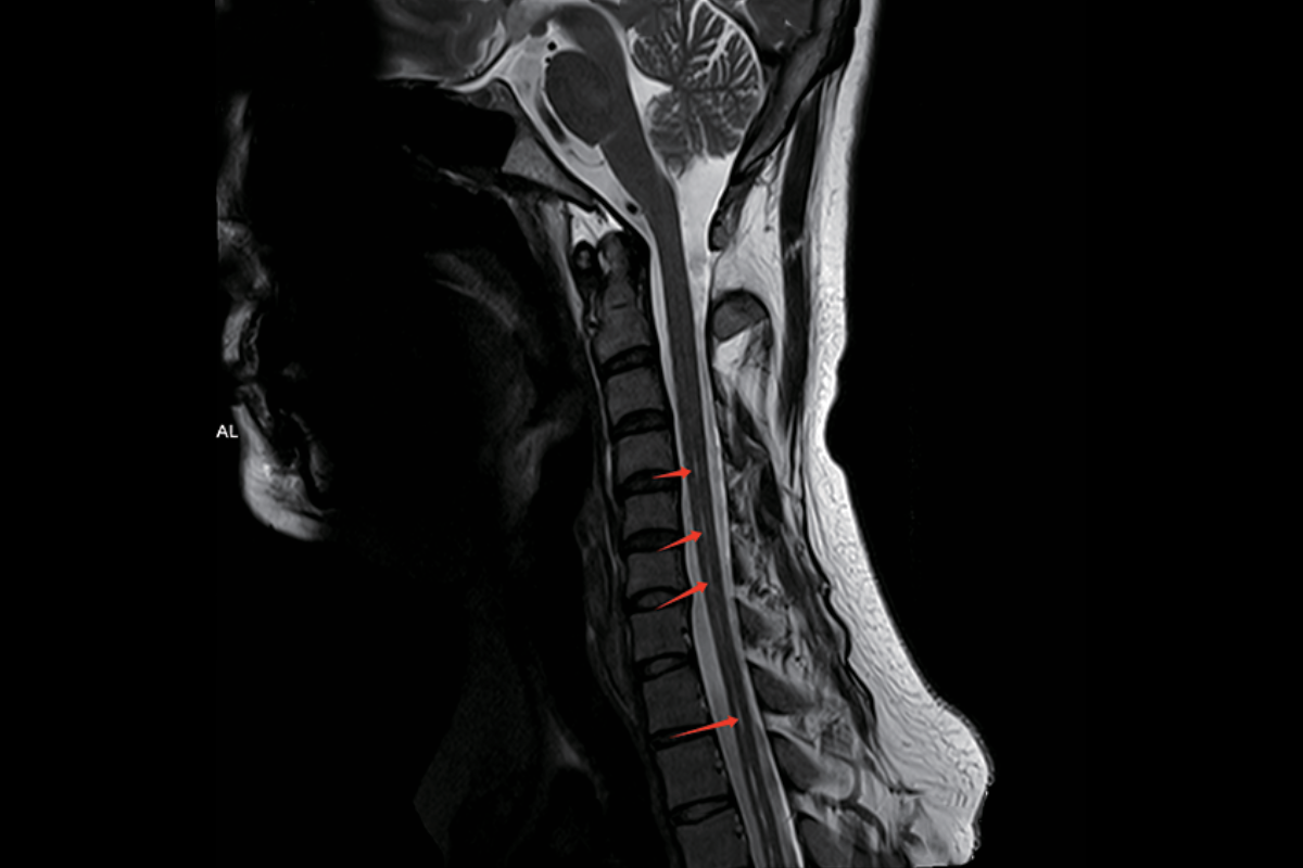 脊髓空洞症T2，Sag