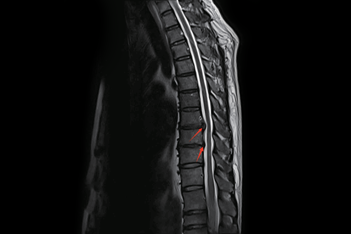 胸椎T2，Sag<br>（T8-9、T9-10椎間盤後緣膨隆，相應硬膜囊受壓，相應椎管變窄）