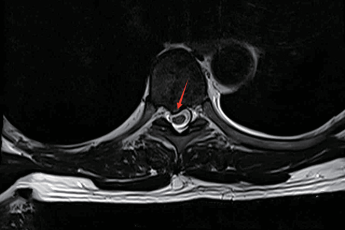 胸椎T2，Tra<br>（椎間盤後緣膨隆，相應硬膜囊受壓，相應椎管變窄）