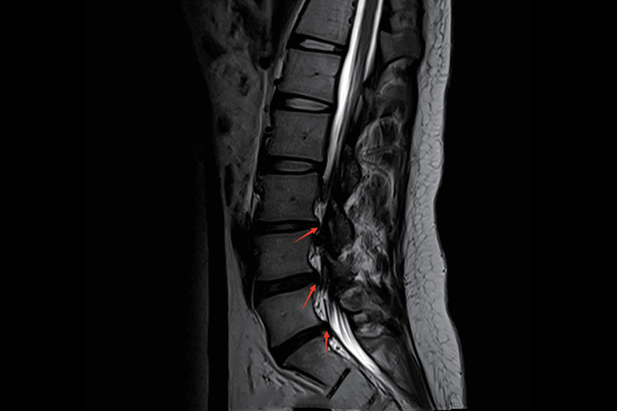 腰椎T2，Sag<br>（椎間盤向後錘樣脫出，硬膜囊及雙側側隱窩明顯受壓，椎管前後徑變窄）