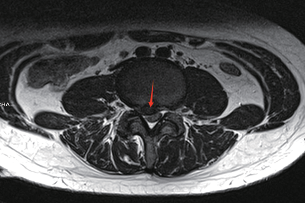腰椎T2，Tra<br>（椎間盤脫入椎管內）